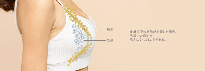 脂肪豊胸で皮下直下に脂肪が定着したケースの危惧