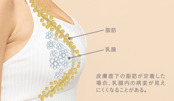 脂肪豊胸で皮下直下に脂肪が定着したケースの危惧