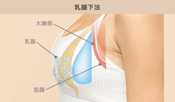 シリコン豊胸の乳腺下法で挿入する場所