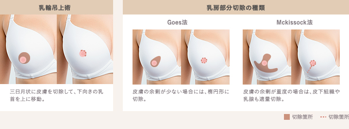 乳房部分切除術の種類