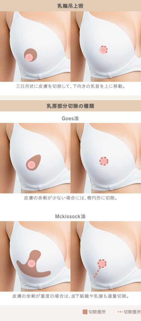 乳房部分切除術の種類