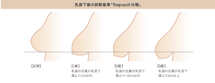 垂れ乳（乳房下垂）の診断基準