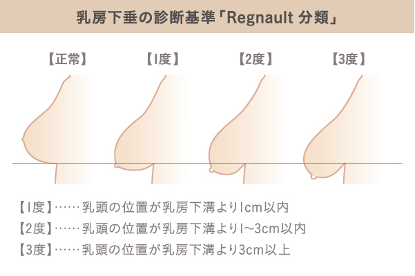 垂れ乳（乳房下垂）の診断基準