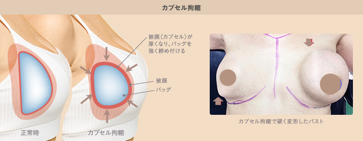 カプセル拘縮で硬く変形した不自然なバスト