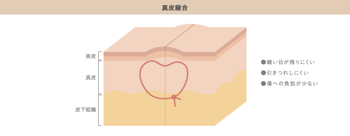 形成外科で行われる真皮縫合のメリット