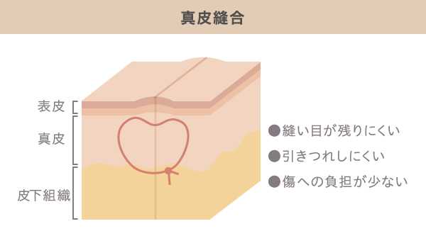 形成外科で行われる真皮縫合のメリット