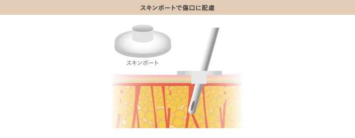 傷口を保護するスキンポート