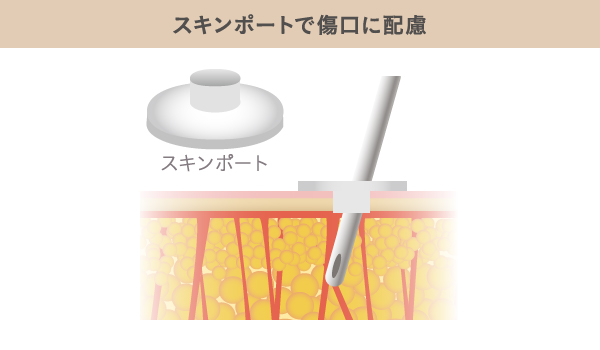 傷口を保護するスキンポート