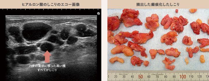 ヒアルロン酸のしこりのエコー画像と摘出した瘢痕化したしこり