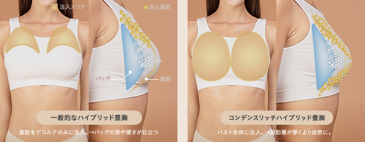 より自然で大きいバストアップにこだわったバストクリニックのコンデンスリッチハイブリッド豊胸と通常のハイブリッド豊胸の違い