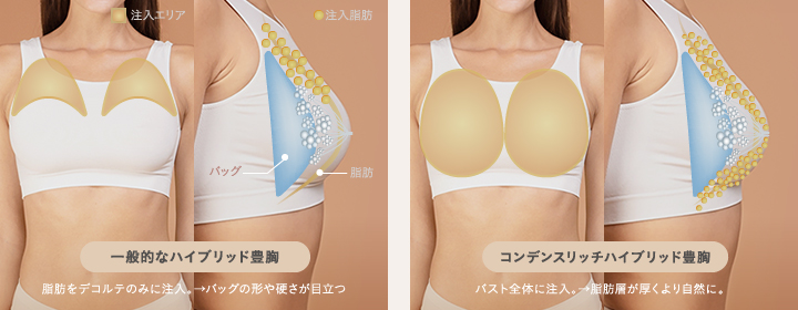 一般的なハイブリッド豊胸とコンデンスリッチハイブリッド豊胸の違い