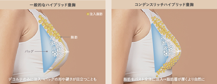 一般的なハイブリッド豊胸と当院のハイブリッド豊胸の違い