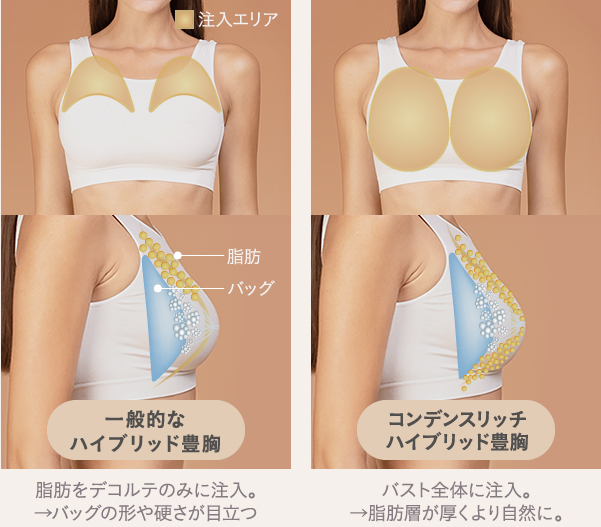 一般的なハイブリッド豊胸とバストクリニックのコンデンスリッチハイブリッド豊胸の違い