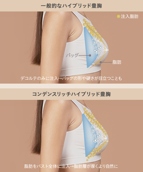 一般的なハイブリッド豊胸と当院のハイブリッド豊胸の違い