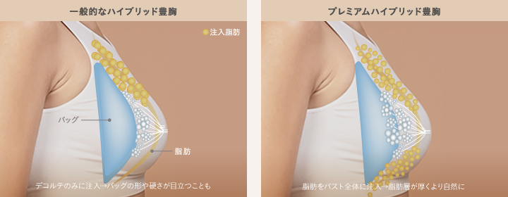 バストクリニックのハイブリッド豊胸症例