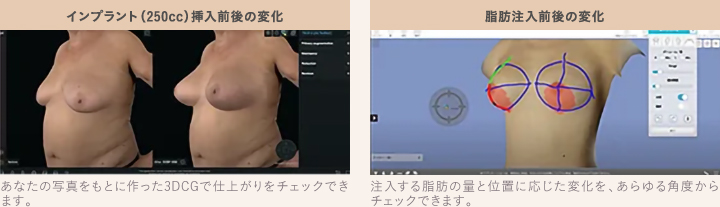 バストクリニックのプレミアムハイブリッド豊胸と通常のハイブリッド豊胸の違い