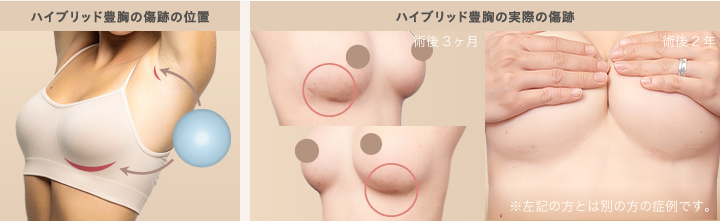 バストクリニックのハイブリッド豊胸症例
