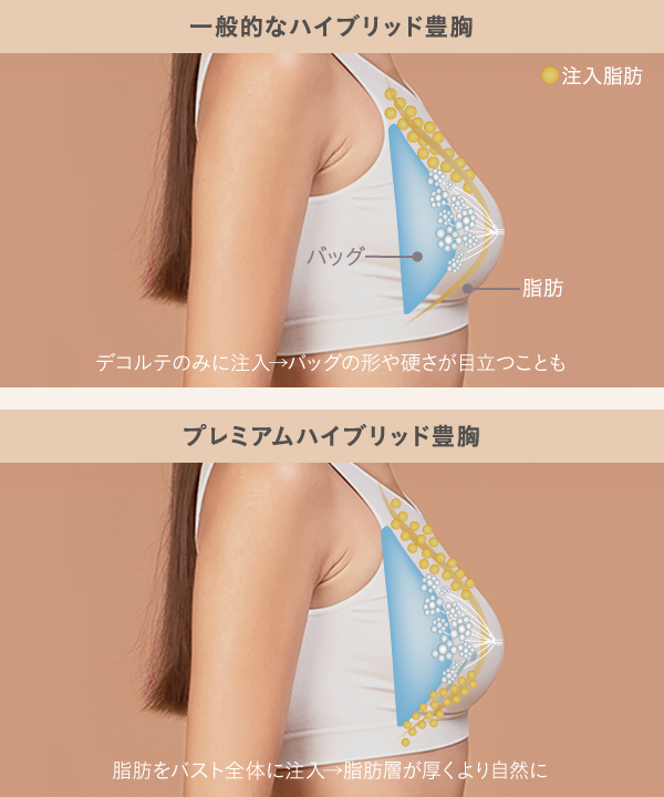 バストクリニックのプレミアムハイブリッド豊胸と通常のハイブリッド豊胸の違い