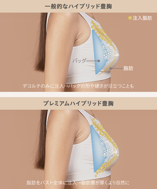 バストクリニックのハイブリッド豊胸症例