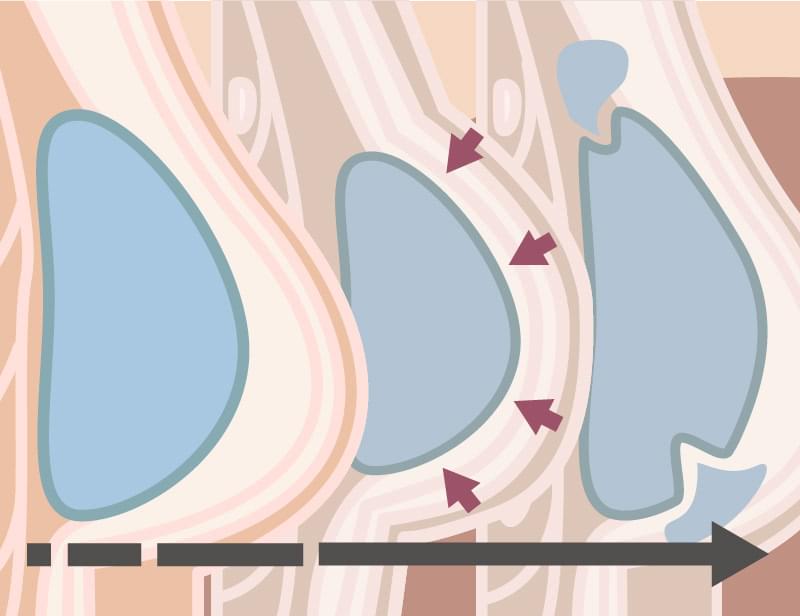 豊胸シリコンは一生もの?医師が語るデメリットと回避法