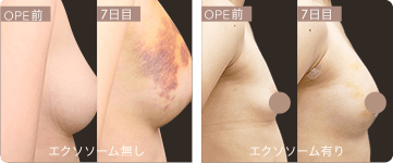 エクソソーム点滴 イメージ
