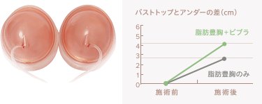 乳房拡張器「ビブラ」 イメージ
