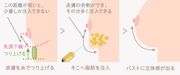 リゴトミー＋糸リフト イメージ