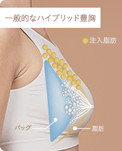 一般的なハイブリッド豊胸