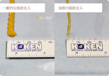 一般的な脂肪注入 / 当院の脂肪注入