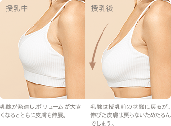脂肪注入豊胸 イメージ