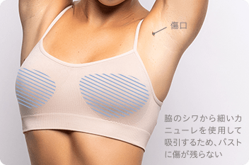 脂肪吸引 イメージ