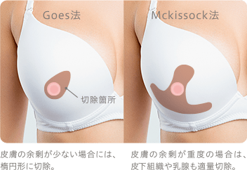 乳房部分切除 イメージ