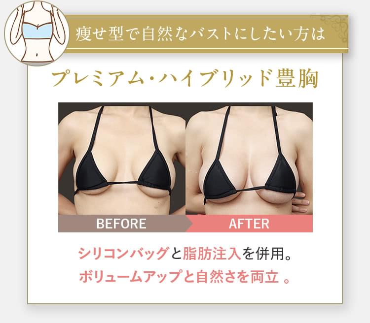 痩せ型で自然なバストにしたい方は プレミアム・ハイブリッド豊胸 シリコンバッグと脂肪注入を併用。ボリュームアップと自然さを両立。