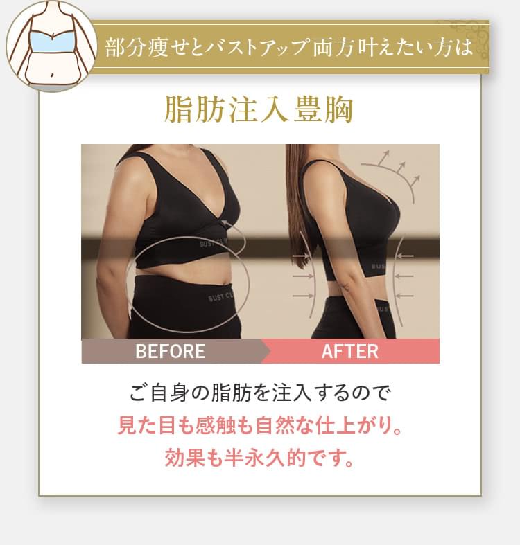 部分痩せとバストアップ両方叶えたい方は 脂肪注入豊胸 ご自身の脂肪を注入するので見た目も感触も自然な仕上がり。効果も半永久的です。