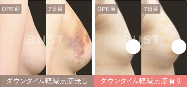 ダウンタイム軽減点滴無し ダウンタイム軽減点滴有り