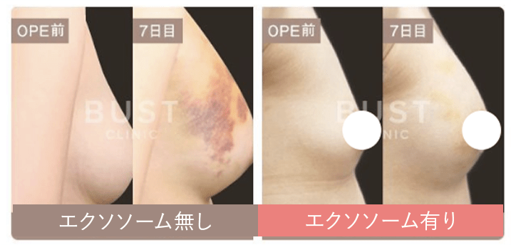 エクソソーム無し エクソソーム有り